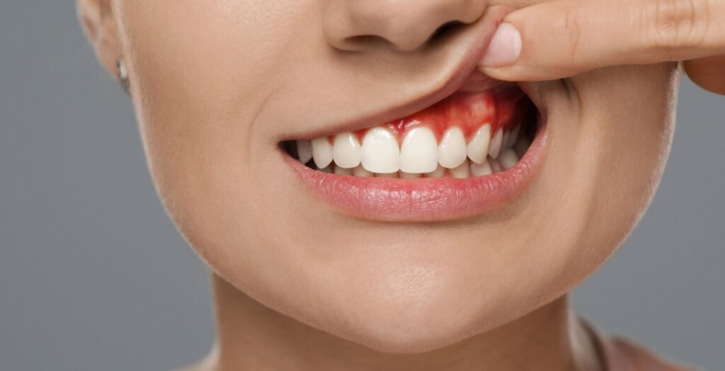 Dental Abscess