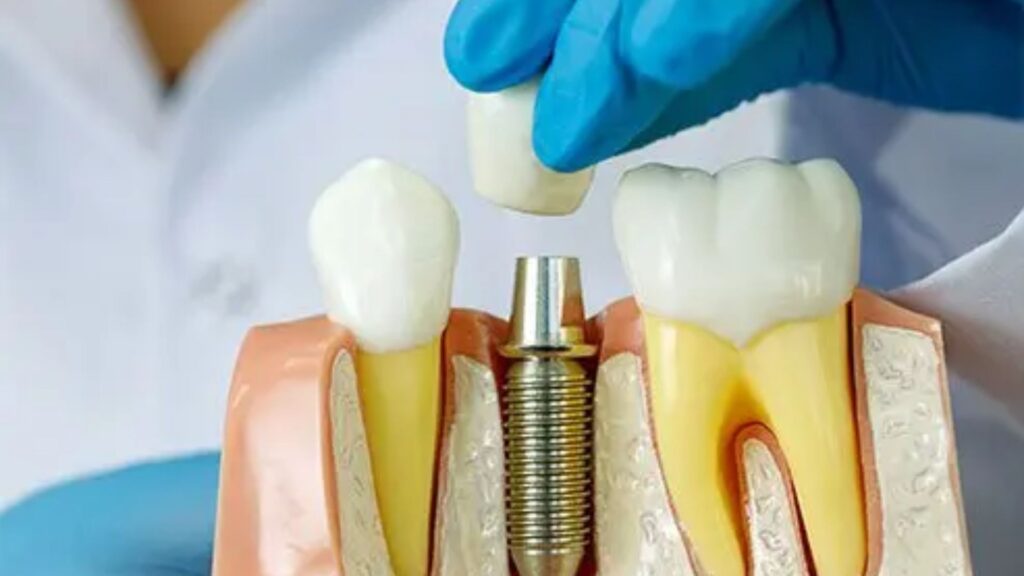 Dental Implants in Bristol CT
