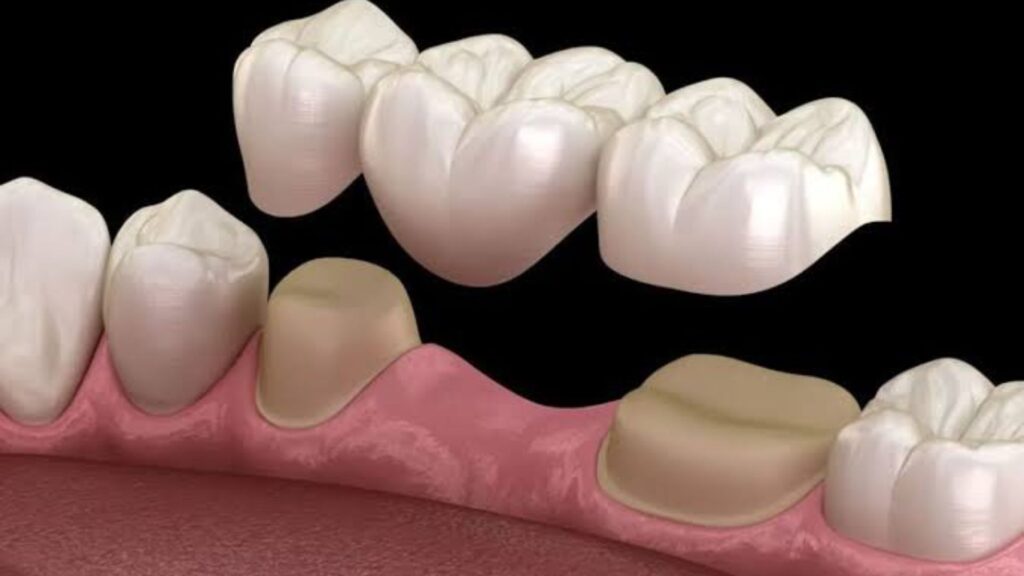 Dental Bridges in Bristol CT